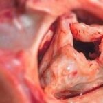 Renta po operacji zastawki serca – warunki, kryteria i potrzebne dokumenty